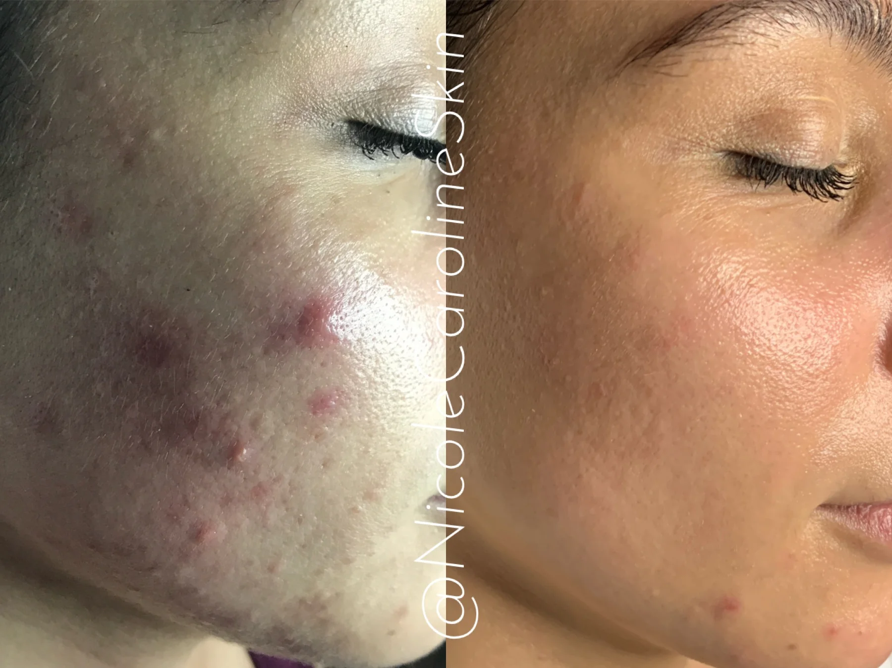 Before and After Results by Nicole Caroline Skin Professional in Greenwich, CT